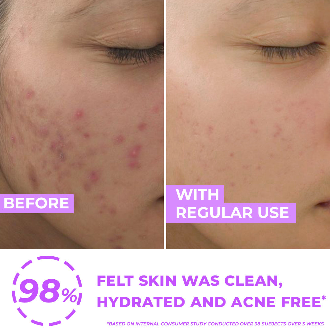 Before and after using Dewdrop anti acne face wash