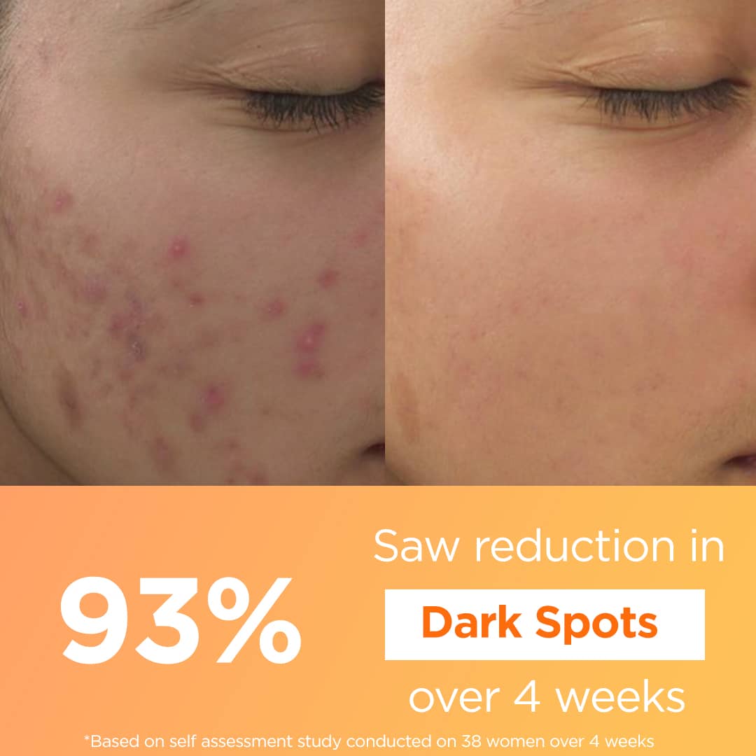 Before and after use of Blaze vitamin c serum